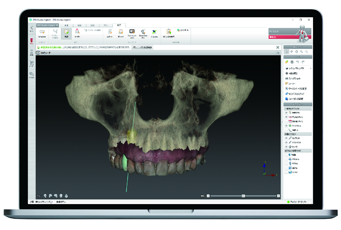 西鉄久留米駅から徒歩5分の歯医者・矯正歯科・インプラント「菊池歯科矯正歯科医院」|マウスピースを装着